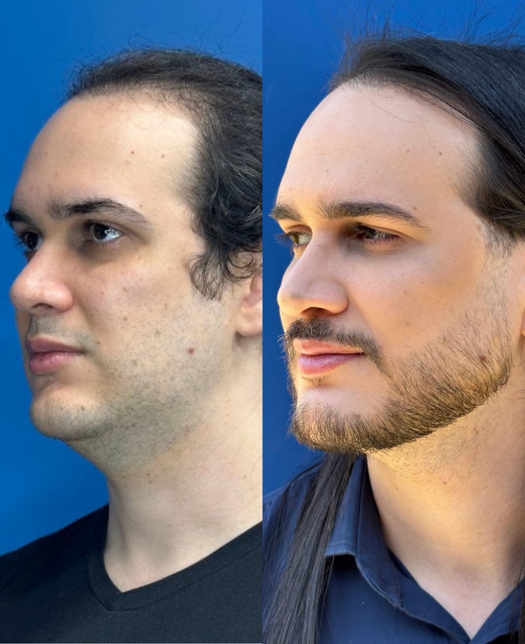 Harmonização facial